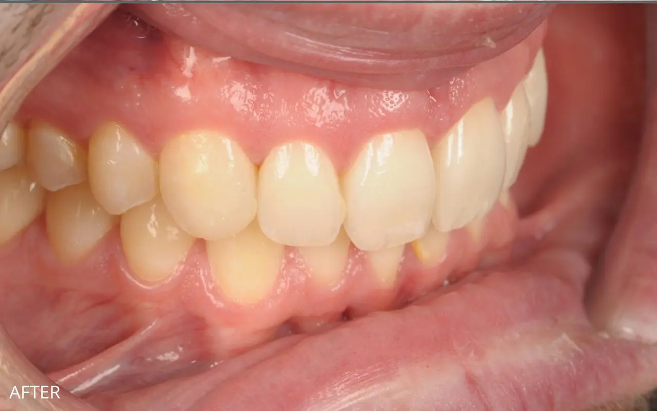 Complete smile makeover with clear aligners, bonding and whitening — after treatment
