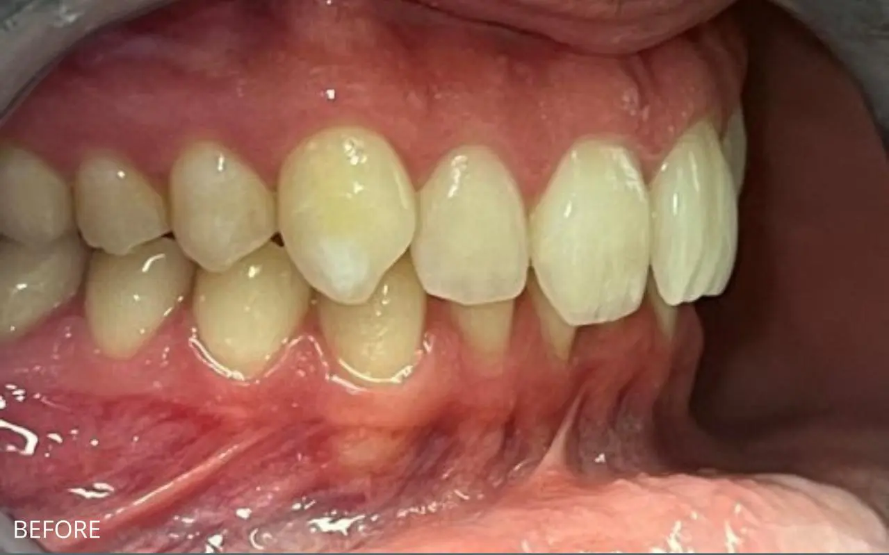 Complete smile makeover with clear aligners, bonding and whitening — before treatment