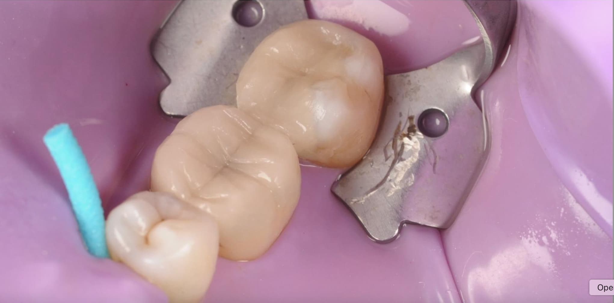 Old amalgam filling replaced with white composite — after treatment