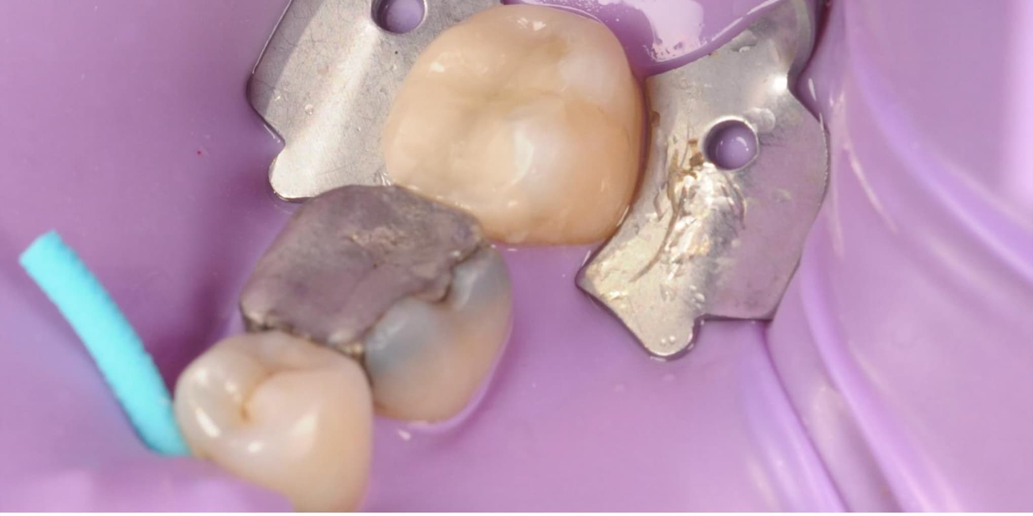 Old amalgam filling replaced with white composite — before treatment