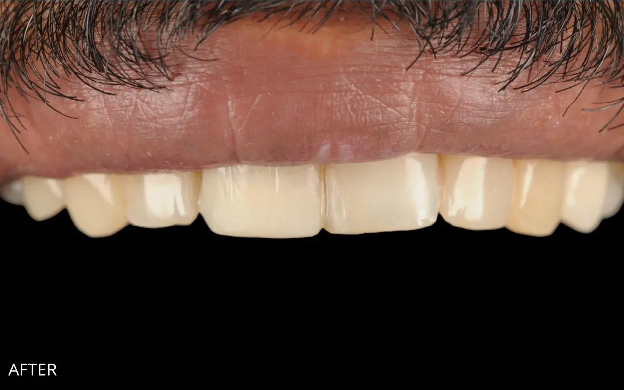 Front teeth composite bonding transformation — after treatment