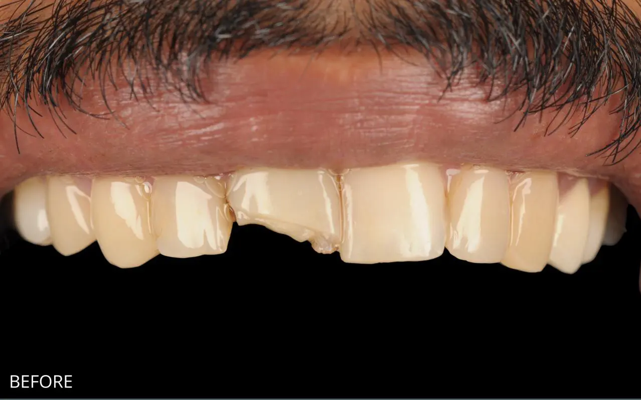 Front teeth composite bonding transformation — before treatment