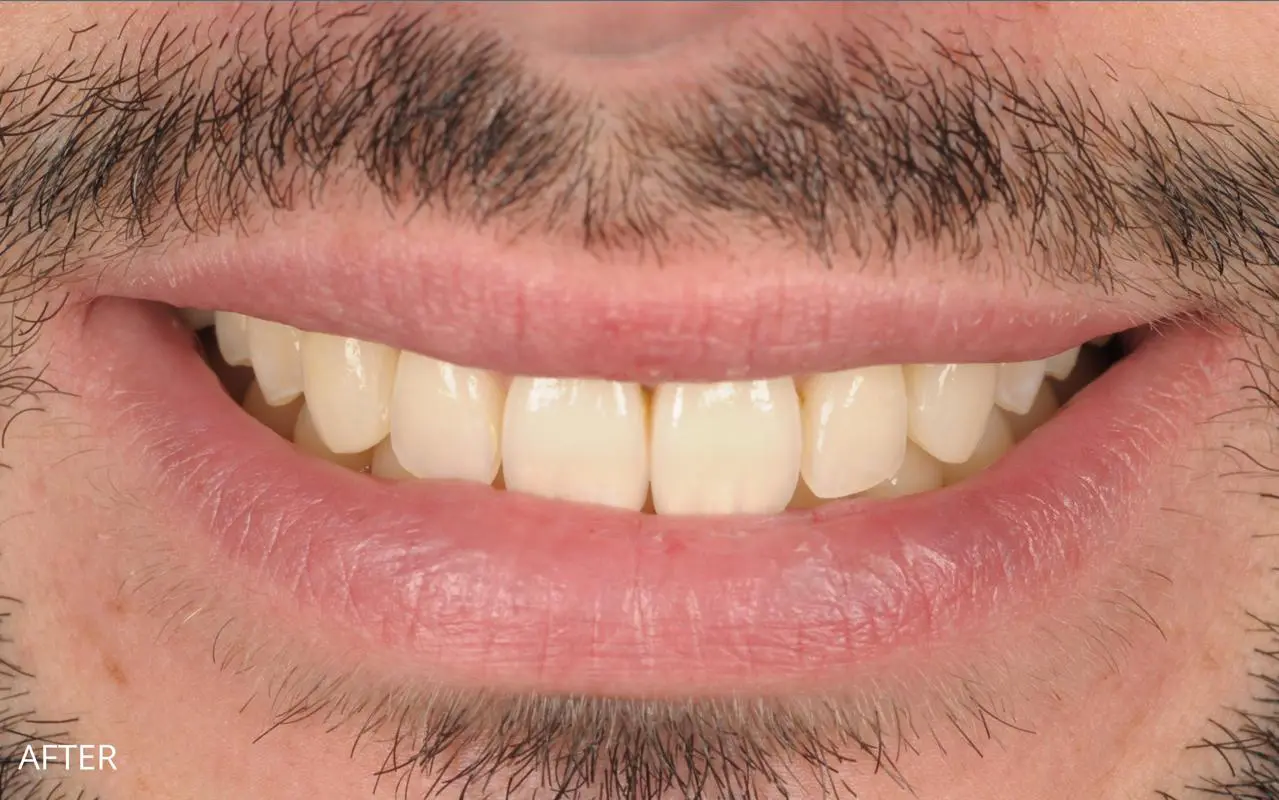 Full veneer smile makeover — after treatment
