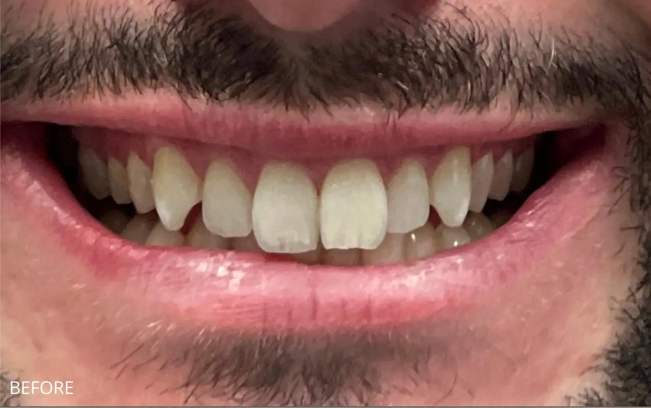 Full veneer smile makeover — before treatment