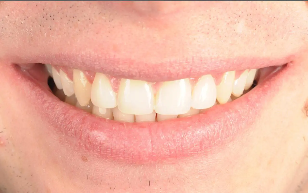 Closing gaps between teeth with composite bonding — after treatment