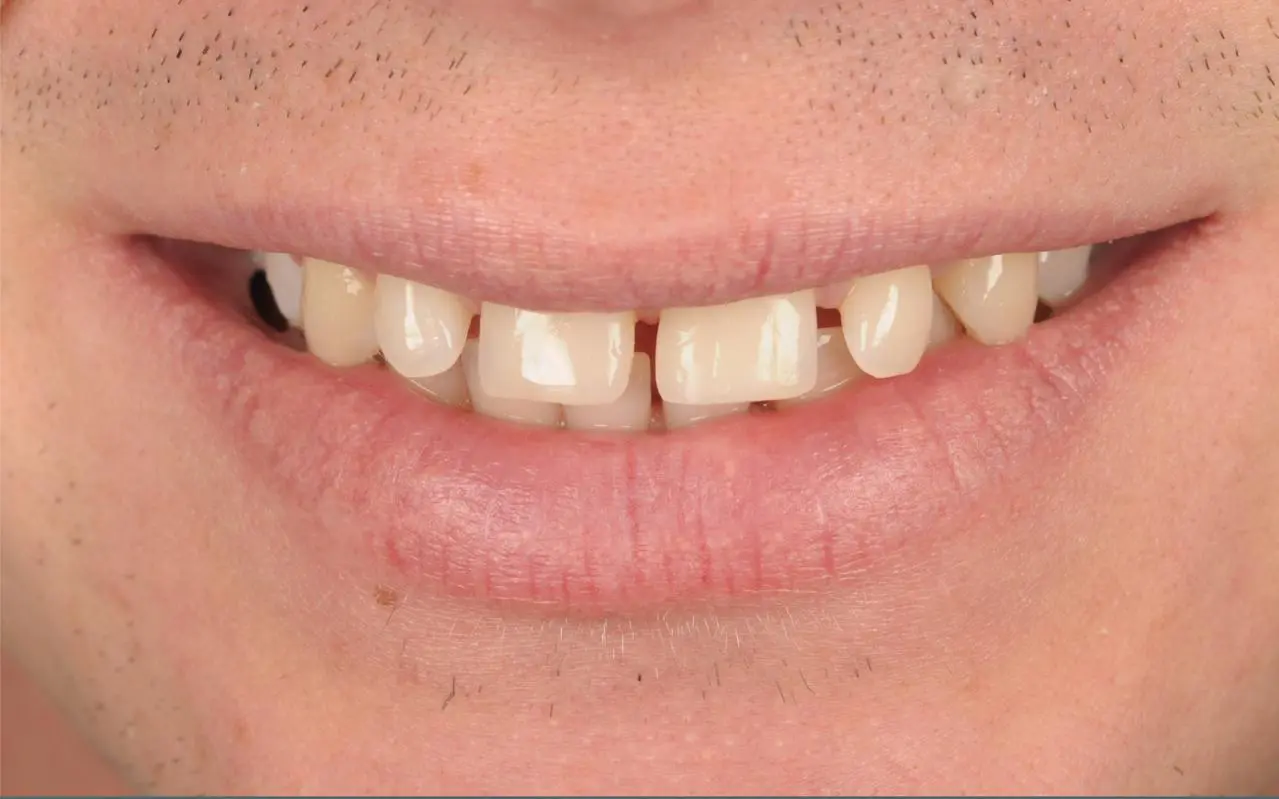 Closing gaps between teeth with composite bonding — before treatment