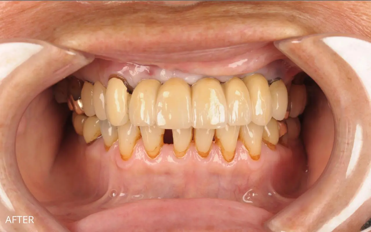 Front teeth replaced with an implant-supported bridge — after treatment