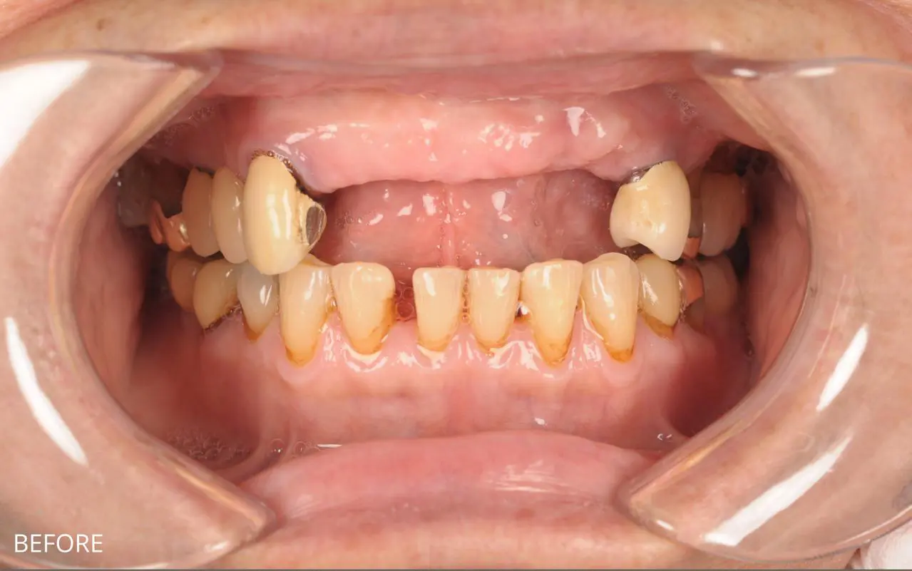 Front teeth replaced with an implant-supported bridge — before treatment